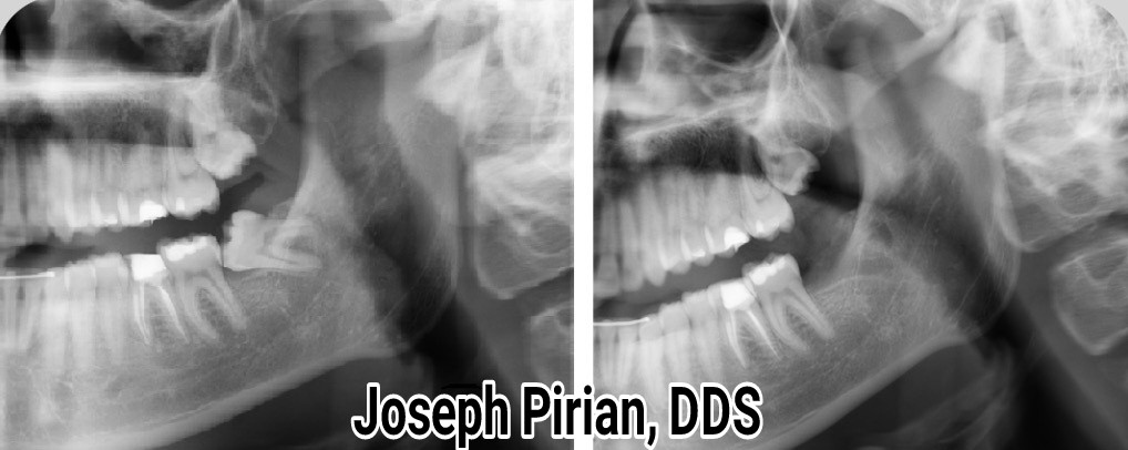tooth extraction panorama city