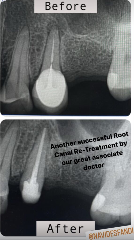 root canal panorama city