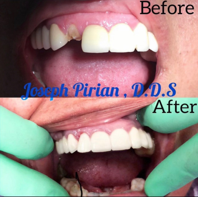 porcelain crowns panorama city